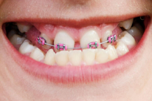 Braces to correct underbite